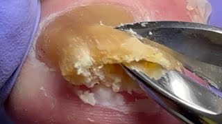 Trim onychomycosis super thick nails very large nails【Doctor Liu Pedicure】 [upl. by Gow]