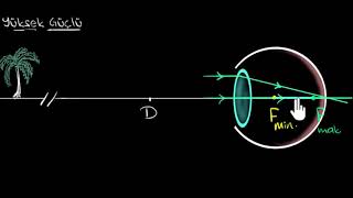 Miyopi ve Hipermetropi Fen Bilimleri Fizik [upl. by Hinson140]