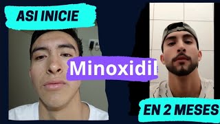 Usando Minoxidil 2 MESES [upl. by Yanej896]