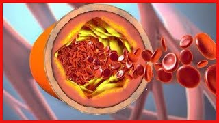 Fibromuskuläre Dysplasie Diagnose und Behandlung [upl. by Rebecca44]