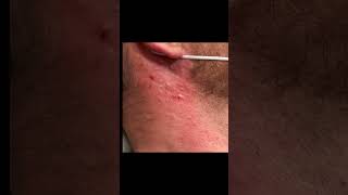 Satisfying Saucy Blackheads [upl. by Ibmat]