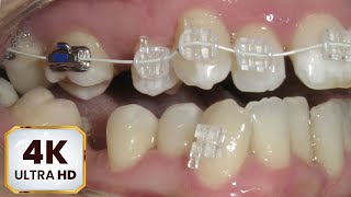 HOW BRACES WORK Sapphire braces Protruding chin in ADULT patient 4k Crossbite timelapse [upl. by Sauveur821]