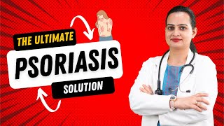 Best Treatment to Cure Psoriasis That Doctors Wont Tell You  Bharat Homeo Skin Treatment Global [upl. by Leamhsi]