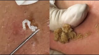 Most Satisfying Blackhead Removal Compilation Ultimate Extraction Videos [upl. by Morvin]