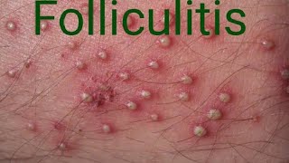 Folliculitis furuncle carbuncle [upl. by Zalucki]