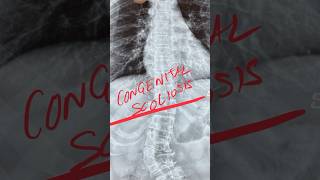 Congenital Scoliosis [upl. by Shawn130]