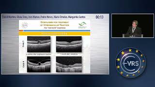 Ocriplasmin for Treatment of Vitreomacular Traction Our Realworld Experience [upl. by Inotna524]