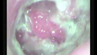 CSOM WITH GRANULATIONS IN MIDDLE EARwmv [upl. by Jamila]