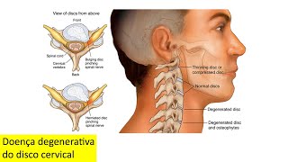 Doença degenerativa do disco cervical [upl. by Fleming752]