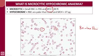 Hematology  1  U7L1  Introduction to microcytic hypochromic anaemias [upl. by Jefferson687]