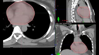 Eclipse Contouring Series Heart Pericardium [upl. by Custer]