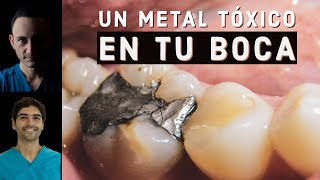 ¿La amalgama dental es tóxica Dentista biológico nos explica [upl. by Winston]