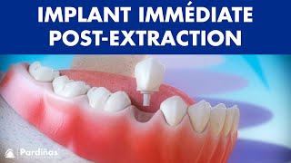 Implant dentaire immédiate postextraction dentaire © [upl. by Wylma]