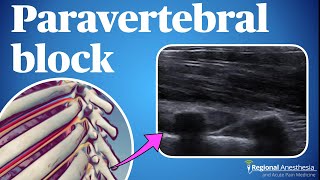 Ultrasound guided thoracic paravertebral block [upl. by Corrie]