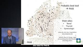 Diagnosis of Metastatic Renal Cancer with Sean Williamson MD [upl. by Kampmeier124]