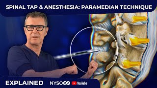 Spinal Tap  Anesthesia Paramedian Technique  Crash course with Dr Hadzic [upl. by Carling]