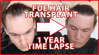 FUE Hair Transplant Timeline 1 YEAR  day 1365  12 Months Progress Before and After [upl. by Nosylla]