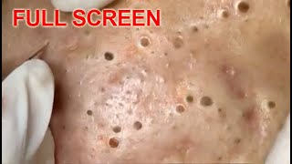 LARGE Blackheads Removal  Best Pimple Popping Videos [upl. by Killie]