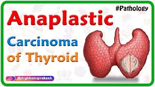 Anaplastic carcinoma of thyroid  Pathology USMLE Step 1 [upl. by Tann398]