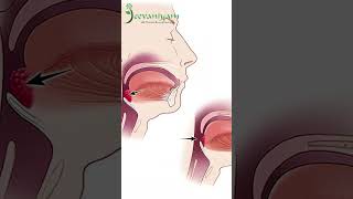 Head And Neck Cancer  National Cancer Awareness Month [upl. by Haughay409]