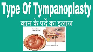 Types of tympanoplasty कान के पर्दें का इलाज factsandmeinhindi [upl. by Schreiber]