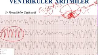 EKG  Ventriküler Aritmiler ECG  Ventricular Arrhythmias [upl. by Valencia]