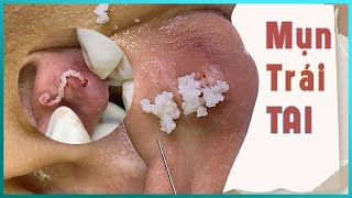 Big Cystic Acne Blackheads Extraction Blackheads amp Milia Whiteheads Removal Pimple Popping [upl. by Liuqa]