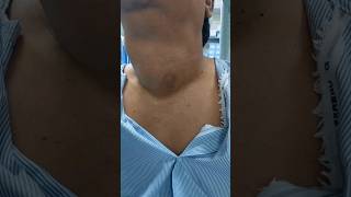 THYROID GOITER patient from TIRUPATI  kya hum unki thyroid SURGERY ko rok sake thyroidnodule [upl. by Letnohc]