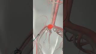 Learn How Cardiac Catheterization Works [upl. by Assi]