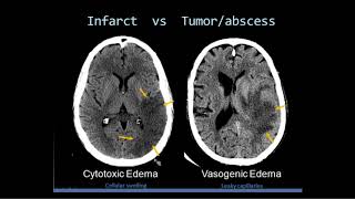 Intro to Head CT Part II Evaluation of Ischemic Stroke [upl. by Letnom463]