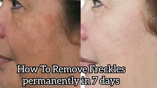 How To Remove Freckles Permanently At Home In Very Easy Way [upl. by Oramug]