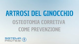 🔴 PROTESI del GINOCCHIO ▷▷ Osteotomia correttiva per prevenire lartrosi al ginocchio [upl. by Eillil]