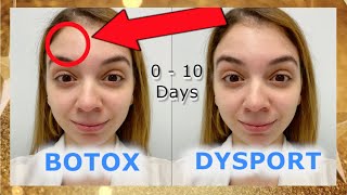 Botox Vs Dysport  Before and After [upl. by Hada]