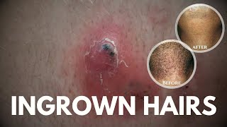 What are Ingrown hairs How to get rid of ingrown hairs [upl. by Kinson222]