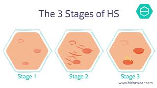 What is Hidradenitis Suppurativa [upl. by Annoyk]