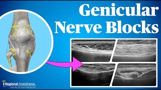 Ultrasound Guided Genicular Blocks 2024 update [upl. by Aiyt]