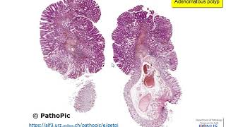 Colon Familial Adenomatous Polyposis [upl. by Creath784]