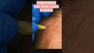 carboxythérapie pour traiter la chute de cheveux [upl. by Oicirtap]