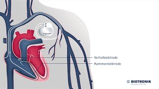 Herzschrittmacher Aufbau amp Funktion Animation Medizin [upl. by Enner]