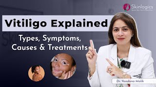 VitiligoLeucoderma  Causes and Treatment  Best Skin Specialist in Noida  Dr Vandana Malik [upl. by Demetra]