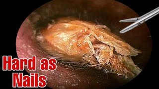 Unbelievable mass of mans Earwax  Earwax removal  Doctor Anh [upl. by Tezzil11]