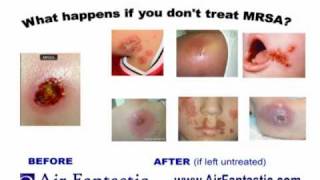 Recognize amp Prevent MRSA Air Fantastic Educational Video [upl. by Yelrak]