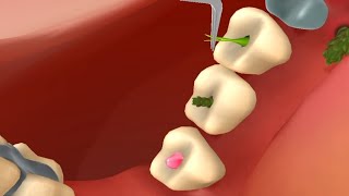 teeth cleaning by animation treatment kidsvideo asmrvideo satisfying [upl. by Niobe695]