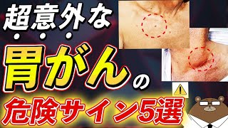 放置厳禁！絶対に見逃さないで！知らないと後悔する胃がんの危険な5つの症状とは？ [upl. by Lyrak564]