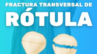 FRACTURA TRANSVERSAL DE RÓTULA [upl. by Clayborne707]