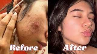 How Spironolactone Cured My Hormonal Acne 2 years  progress pictures [upl. by Raymond]