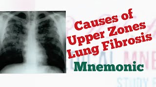 Upper Lobe Lung Fibrosis Causes Mnemonic by MedSurvival [upl. by Enuj]