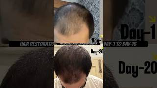 Hairline Restoration Journey Day 15 Using Derma Roller amp Regrowth Serum  Real Resultsrestorehair [upl. by Hnaht906]