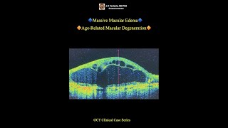 Massive Macular Edema AgeRelated Macular Degeneration [upl. by Denbrook427]