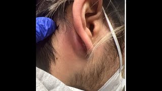 Mastoiditis vs Posterior Auricular Abscess andor Epidermoid Cyst [upl. by Pamella888]